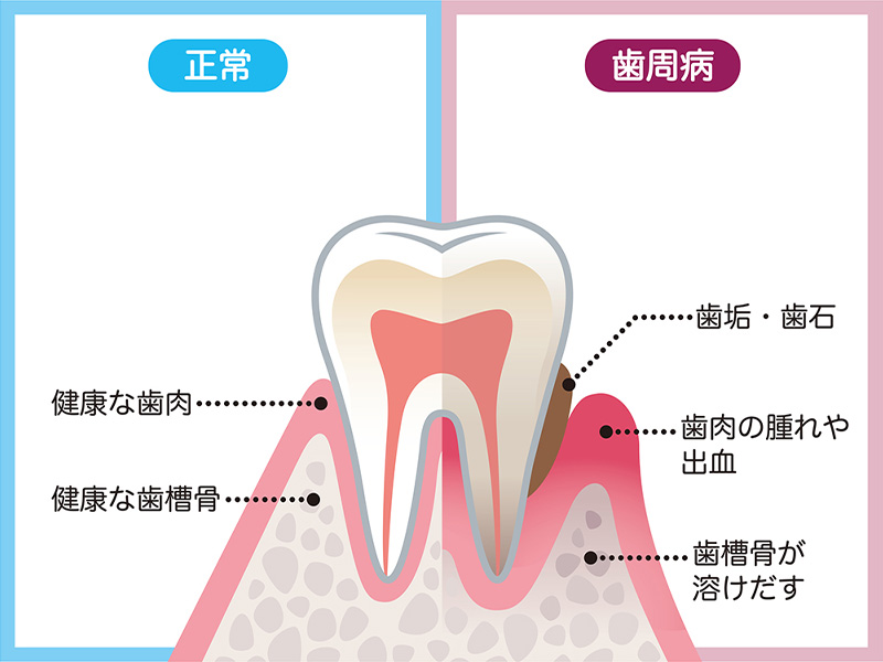 歯周病治療